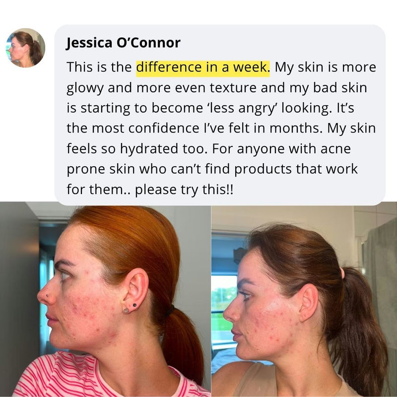 Jessica skincare transformation